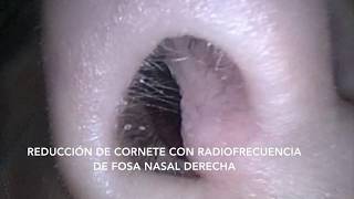 Radiofrecuencia de cornetes [upl. by Htiderem]