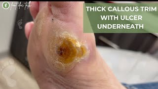 THICK CALLOUS TRIM REVEALS ULCER UNDERNEATH [upl. by Rogerio]