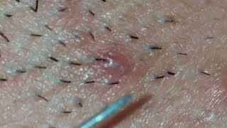 Biggest Ingrown Hair Removed from Beard 2019 [upl. by Shult]