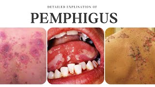 Pemphigus Types Causes Clinical Features Differential Diagnosis and Treatment [upl. by Keary]