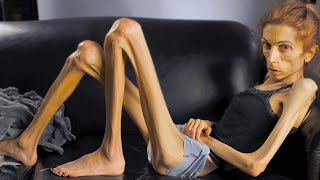 This Is the Thinnest Person In The World [upl. by Eizzik]