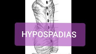 Hypospadias [upl. by Dympha]