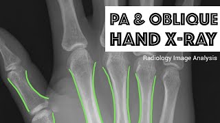 Radiology Image Analysis PA amp Oblique Hand XRay [upl. by Eihpos673]