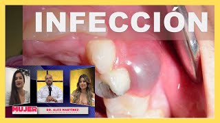 Infección DENTAL 😳 ¿Cuántos TIPOS hay AQUÍ lo SABRÁS 🎓 [upl. by Fishbein]