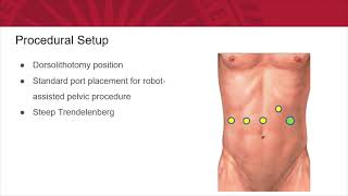 ketamine bladder  Studer Type Neobladder Augment [upl. by Tdnerb]