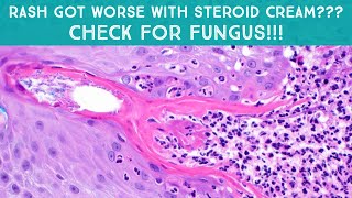 Rash got WORSE with topical steroids Check for fungus tinea incognito“ringworm” Dermatology [upl. by Alsi]