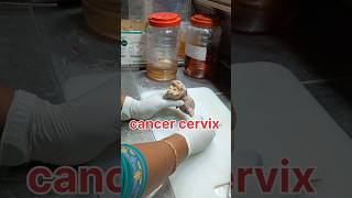 Cancer cervix specimen grossing pathology cancer cervicaltreatment cervicalcancersymptoms [upl. by Rocca932]