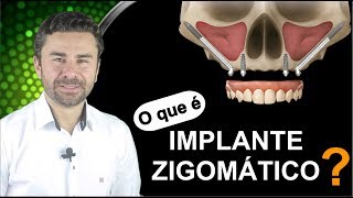 O que é Implante Zigomático Uma Explicação Rápida e Direta [upl. by Nylarej717]