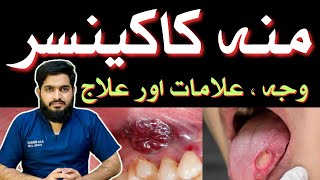 ORAL CANCER  Symptoms  Causes  Treatment  منہ کا کینسر  Urdu  Hindidrmuneermalik [upl. by Cherry]