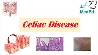 Celiac Disease amp Gluten Sensitivity Risk Factors Pathogenesis Symptoms Diagnosis Treatment [upl. by Netti]