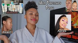 SKINCARE COMMENT JAI REUSSI À TRAITER MES PROBLÈMES DE PEAU ✨️skincare skincareproducts [upl. by Llatsyrk362]