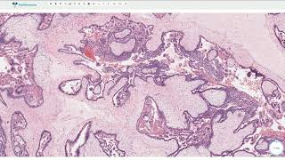 Complete Hydatidiform Mole  Histopathology [upl. by Mastat]