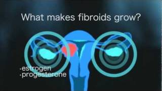 Fibroid Tumors [upl. by Gae]