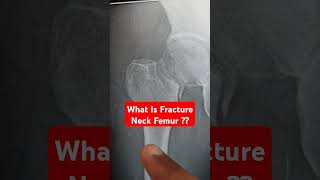 What Is Fracture Neck Femur  Dr Sai Chandra MBBS DNB Ortho FIAS FIJR Germany [upl. by Allesig]