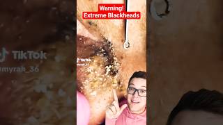 Warning EXTREME BLACKHEAD REMOVAL  How Do You Tackle This shorts [upl. by Cordula]