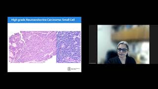 GUPS Virtual Education Series Neuroendocrine Prostate Cancer 05142024 [upl. by Leahey529]