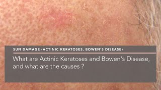 What are Actinic Keratoses and Bowens Disease and what are the causes [upl. by Ruhnke668]