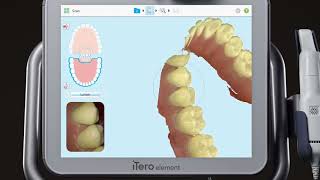 iTero® Scanner Tutorial Using the MultiBite Function [upl. by Nitnert]