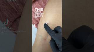 Skin Tag Removal Results  Before amp After 1 treatment of Electrocautery skintagremoval [upl. by Dari]