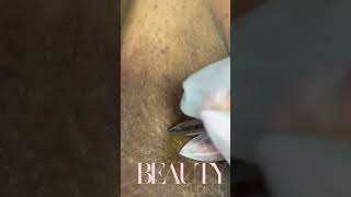 Ingrown Hair Removals [upl. by Asilahs]