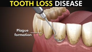 Periodontitis or Gum disease 3d animation included [upl. by Vikki]