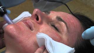 Dr Mark B Taylor Review of Dermapen Micro Needling  Gateway Aesthetics [upl. by Baker]