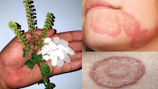 दाद खाज खुजली दिनाय कि सिर्फ़ 2 दिनों में जड़ से छुट्टी कर देगा ये नुस्खा  ringworm treatment home [upl. by Ahsieka]