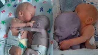 The nurse places a healthy baby next to her dying twin and a miracle happens [upl. by Bradford]