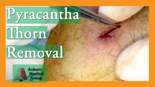 Foreign Body Removal of Pyracantha Thorn  Auburn Medical Group [upl. by Eclud809]