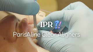 Performing IPR with ParisAline Clear Aligners A Simple Guide [upl. by Laeria]