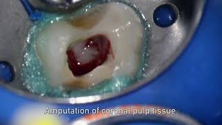 MTA pulpotomy – Video abstract ID 134315 [upl. by Keraj]