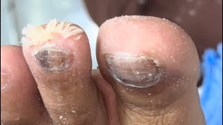 Ep6940 Foot skin removal 👣 นิ้วอื่นก็มีหนังหนาได้ 😄 clip from Thailand [upl. by Volnak]