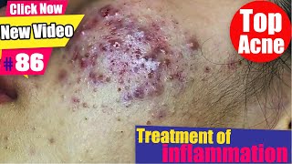 Cases of treatment of inflammation on the face girl  Acne Treatment 86 [upl. by Melly]