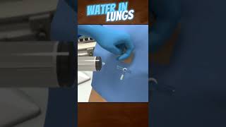 Water in Lungs Treatment  Pleural Fluid Aspiration in 3D [upl. by Amekahs549]