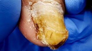 Severely Deteriorated Toenails Not Trimmed For Too Long【Pedicure King】 [upl. by Cyrus]