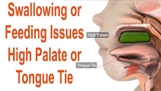 Feeding Or Swallowing Problems Due to High Plate or Tongue Tie [upl. by Suivatco97]