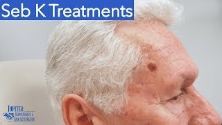 Seborrheic Keratosis Treatment amp Removal Liquid Nitrogen amp Curetagge [upl. by Artened]