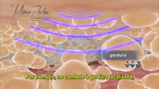 Ultrassom para tratamento de Celulite Gordura Localizada e Flacidez [upl. by Sibley936]