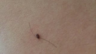 How To Get Rid of Skin Tags Naturally [upl. by Hpeosj]