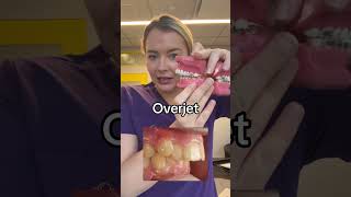 Overjet vs overbite braces overbite overjet [upl. by Auoy]