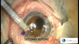 Perforating Keratoplasty PKP by Dr Alex Lange [upl. by O'Carroll]