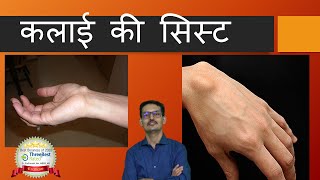 कलाईकीसिस्ट Wrist Ganglion Cyst Hindi [upl. by Lalage]