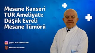 Mesane Kanseri TUR Ameliyatı Düşük Evreli Mesane Tümörü [upl. by Ienttirb84]