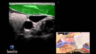 How To Ultrasound Guided Insertion Internal Jugular Catheter Trans  Sonosite Ultrasound 3D Video [upl. by Mcclure]