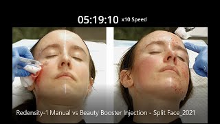 Injection Face Off Manual Injections vs Beauty Booster Injection Device [upl. by Kassia645]