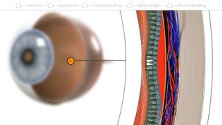 Patientfilm om behandling av gula fläcken våt AMD [upl. by Elleahcim118]