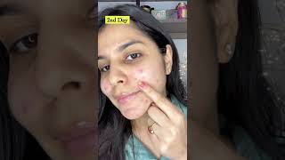 How To Get Rid Of Acne Overnight  Foxtale Spot Corrector Gel Review shorts [upl. by Graniah]