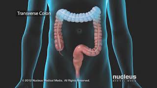 Colon Problems Diverticular Disease [upl. by Yanrahs]