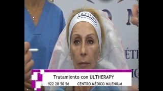 ANTES Y DESPUES TRATAMIENTO MEDICO ULTHERAPY PAPADA Y FLACIDEZ CUELLO [upl. by Olnee]