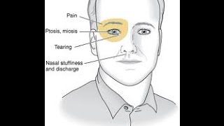 Cluster Headache [upl. by Ellennod]